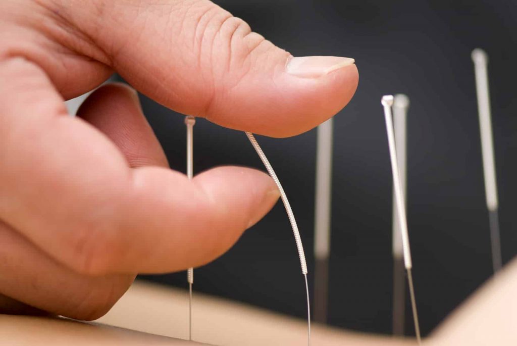 bigstock_acupuncture_12558167